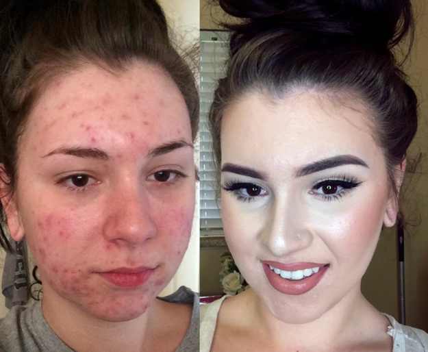 10 Best Makeup Tutorials For Acne With StepByStep Guides